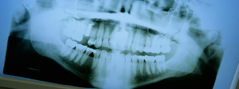 Oralchirurgie in Sindelfingen, Kieferchirurgie
